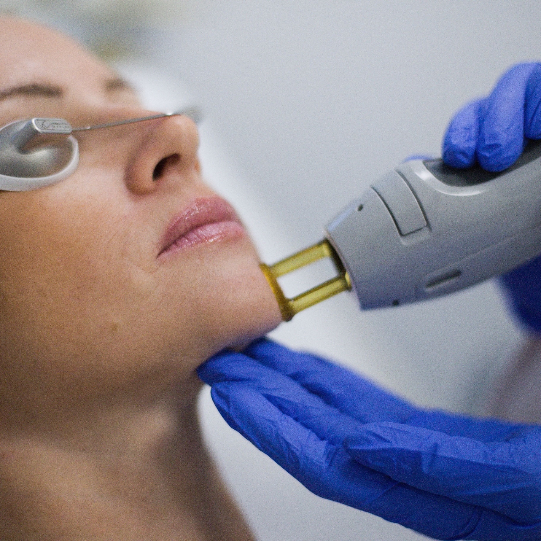 Close-up of a laser aesthetic treatment on a woman's chin, practitioner in blue gloves holding the device